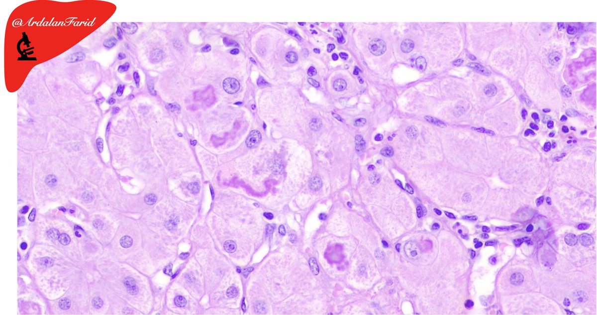 ArdalanFarid's tweet photo. A 44-year-old cirrhotic lady who underwent #liver #transplantation. What’s the #cause of #cirrhosis? What are the salient #histopathologic findings?
#PathTwitter 
#LiverPath
#TUMSpath
#quiz https://t.co/lCQhIfA7C5