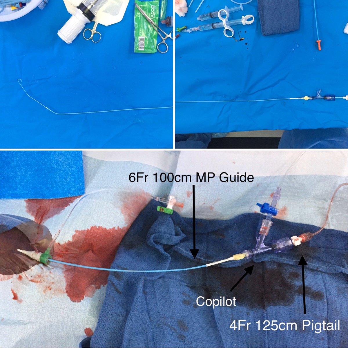 GHernandezMD's tweet photo. After trying a couple alternatives to the Langston catheter. I think this one is by far one of the best alternatives I have used. Able to do it all from #radialfirst and antecubital. @DrMauricioCohen @TheNarulaSeries @DrJayMohan @drmortkern https://t.co/FyDvKGfCzx
