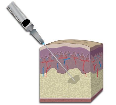 While there's no cure for Dercum's, after years of research, there is a drug under study to treat the lipomas in #dercumsdisease. Read more about it in an interview with Dr. Karen Herbst: buff.ly/2PqFfBo 
#DercumsAwareness2021
#Livingwithdercums