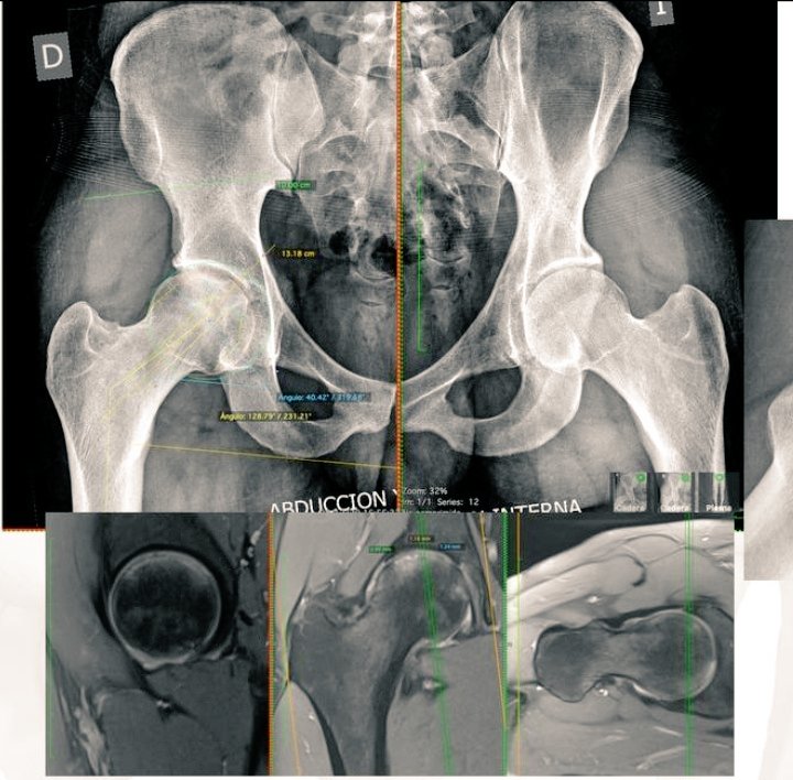 RPURATA's tweet image. 29 yo Male
Right Hip ON
Total Hip RESURFACING
#recons
#orthotwitter
#adultrecons
@caderarodilla
 #DrDarioGarin
Tboughts @DrLeeRubin @hugortopedista @generalorthomd
When arthroscopy?
When arthroplasty?