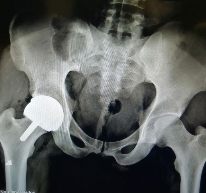RPURATA's tweet image. 29 yo Male
Right Hip ON
Total Hip RESURFACING
#recons
#orthotwitter
#adultrecons
@caderarodilla
 #DrDarioGarin
Tboughts @DrLeeRubin @hugortopedista @generalorthomd
When arthroscopy?
When arthroplasty?