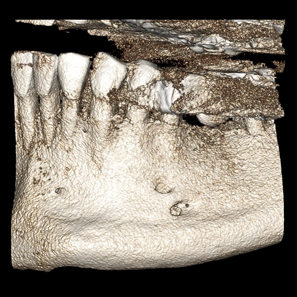 Fun case of two mental foramina on CBCT. #radiographoftheday