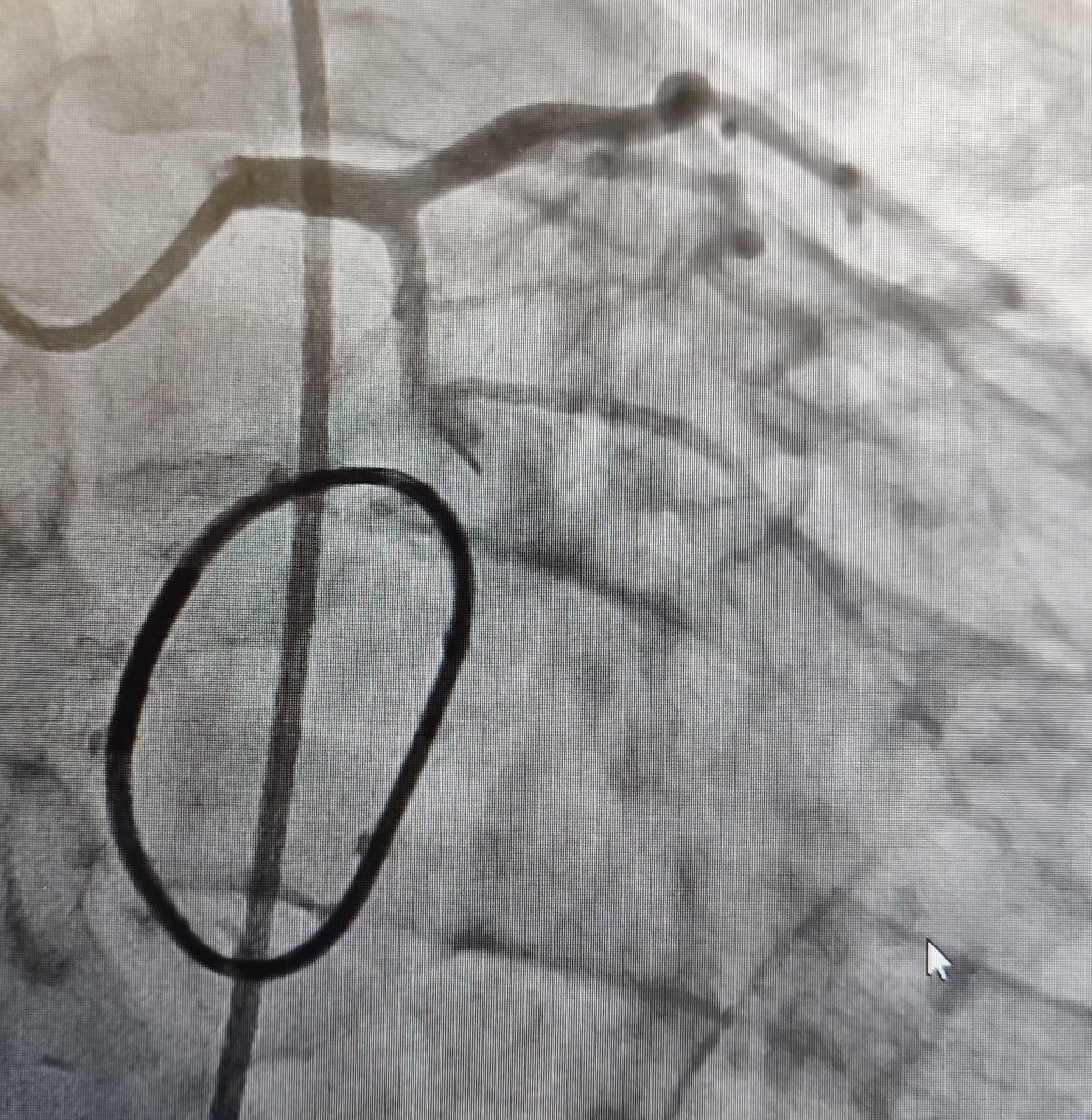 nicolasamabile's tweet photo. 40 y-o man , video-assisted mitral valve repair during the morning, VF + cardiac arrest just after admission in the CCU. Infero lateral on going STEMI related to mid-Cx kinking. Successful rescue PCI with microcatheter+Sion Blue wire + 3.5x24 mm EES &amp; POT.#SurgeryfirstPCIsecond ! https://t.co/xYo9lzwrND