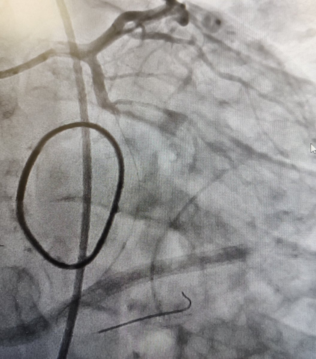nicolasamabile's tweet photo. 40 y-o man , video-assisted mitral valve repair during the morning, VF + cardiac arrest just after admission in the CCU. Infero lateral on going STEMI related to mid-Cx kinking. Successful rescue PCI with microcatheter+Sion Blue wire + 3.5x24 mm EES &amp; POT.#SurgeryfirstPCIsecond ! https://t.co/xYo9lzwrND