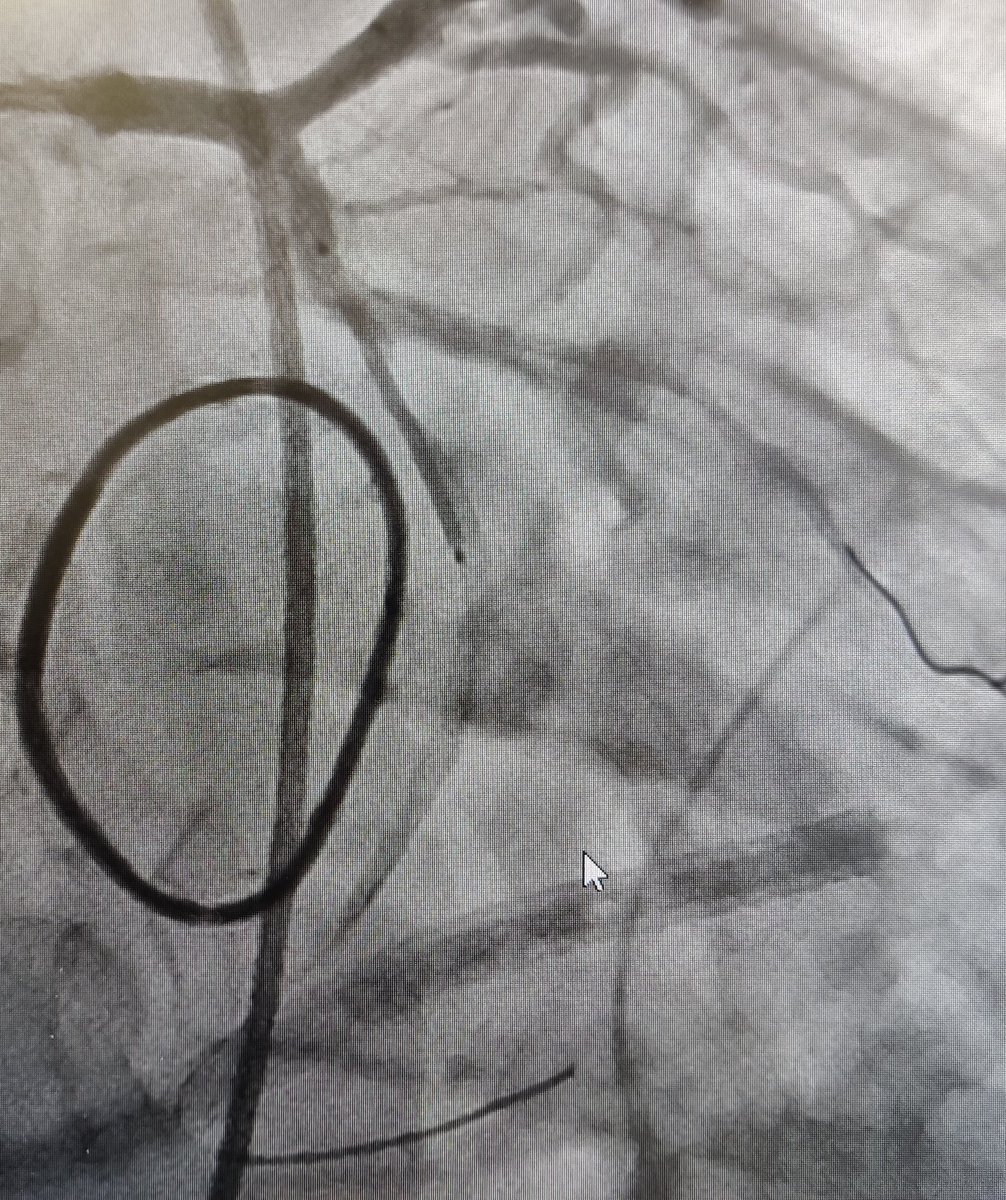 nicolasamabile's tweet photo. 40 y-o man , video-assisted mitral valve repair during the morning, VF + cardiac arrest just after admission in the CCU. Infero lateral on going STEMI related to mid-Cx kinking. Successful rescue PCI with microcatheter+Sion Blue wire + 3.5x24 mm EES &amp; POT.#SurgeryfirstPCIsecond ! https://t.co/xYo9lzwrND