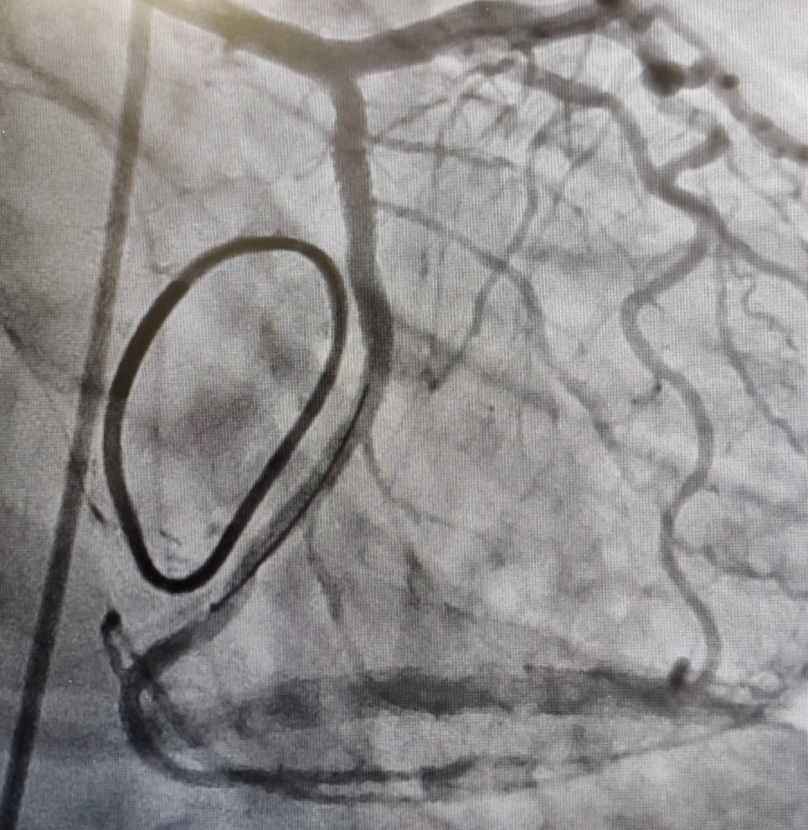 nicolasamabile's tweet photo. 40 y-o man , video-assisted mitral valve repair during the morning, VF + cardiac arrest just after admission in the CCU. Infero lateral on going STEMI related to mid-Cx kinking. Successful rescue PCI with microcatheter+Sion Blue wire + 3.5x24 mm EES &amp; POT.#SurgeryfirstPCIsecond ! https://t.co/xYo9lzwrND
