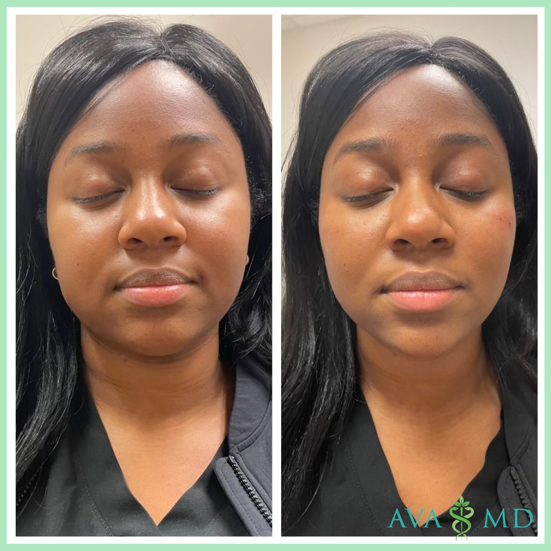 Gorgeous dermal filler results by Ava MD's Robin Perkins, RN. Natural, subtle changes make a huge difference!