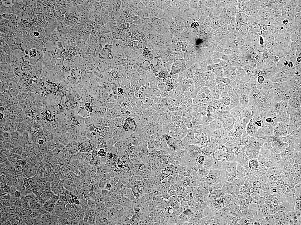 Gabrielasjr's tweet photo. A la izq., célula no infectada.

A la der., célula infectada con la variante brasileña P.1, a 48 horas de posinfección.

Estudios de infección «in vitro» muestran daño celular marcado, con muerte celular abundante.
Esta se evidencia como espacios vacíos en la capa de la célula. https://t.co/mhwvy56k03