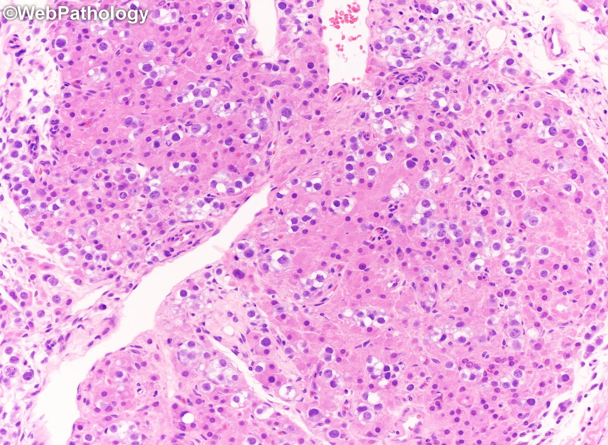 Common tumor with an uncommon presentation. Testicular tumor presenting with gynecomastia. What's going on here? Labs. and additional images to follow. #GUPath