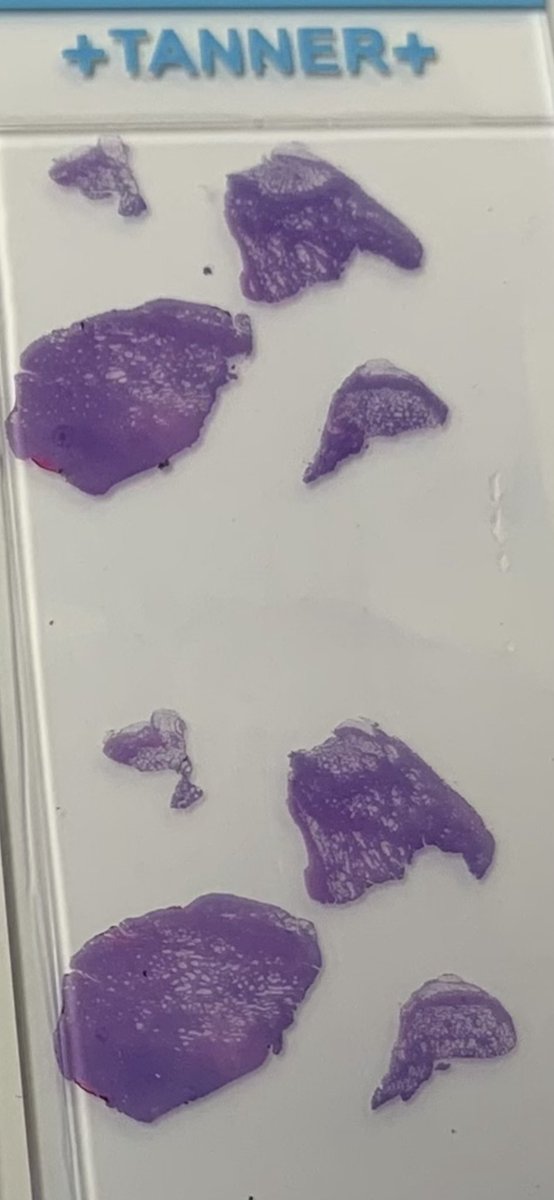 HENRYY_MD's tweet photo. Lesion sent in as “cyst” from a young lady’s upper back. Can you trying using your 1x make eye to generate a ddx?😂 #dermpath #dermatology #pathology #lowpowerdx  @david_terrano @AadilAhmedMD https://t.co/aYH8lWVhGr