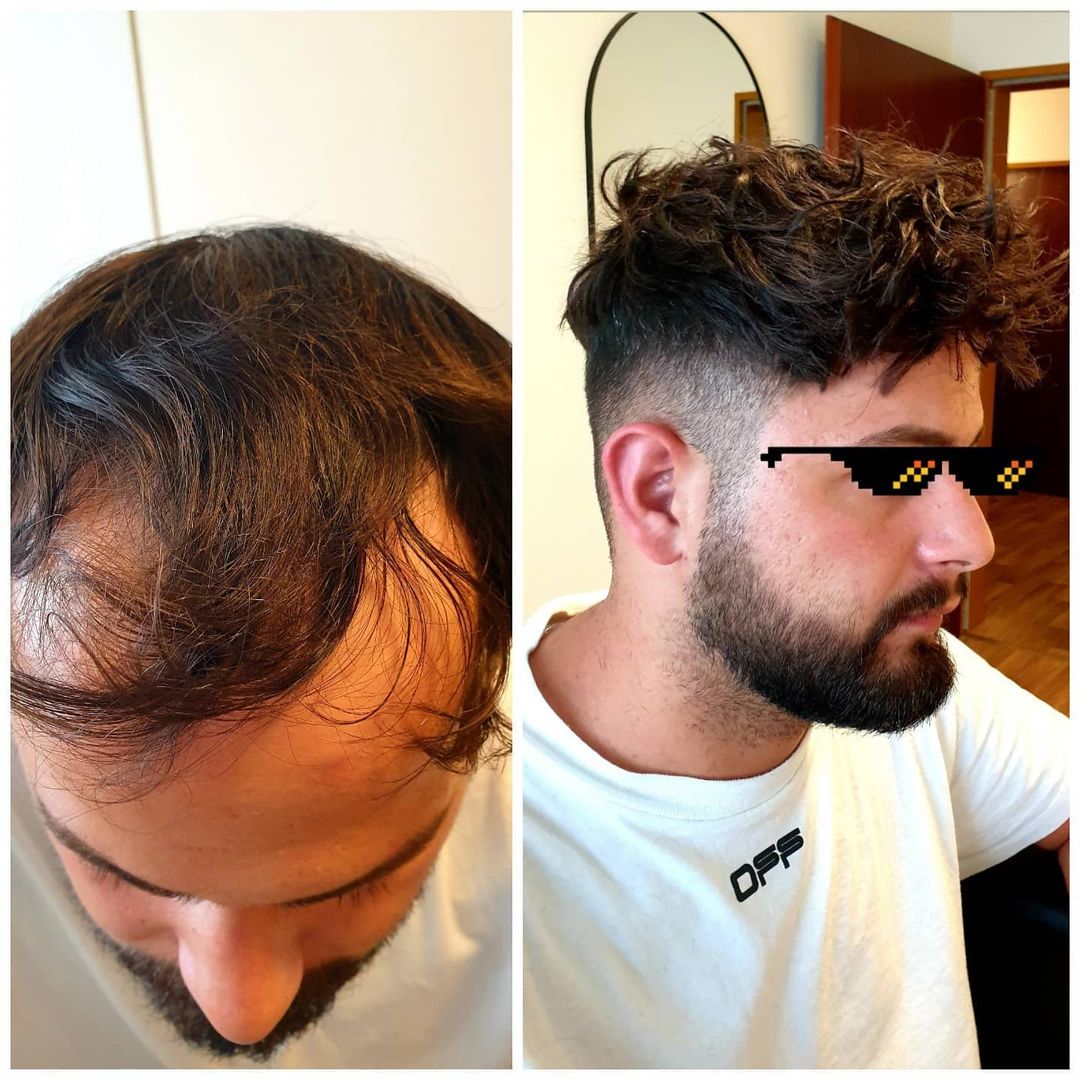 AddBeautymall's tweet photo. A picture is worth a thousand words 🔥
.
.
.
.
.
.
.
.
.
#toupee #toupeeformen #hairline #hairlinerestoration #thinninghair #hairloss #hairlosssolution #hairfashion #hairsalon #hairstyle #wigsmanufaturer #toupeewholesaler #hairfactory #hairreplacementspecialist #addbeautymall https://t.co/I5VW0ykvVP