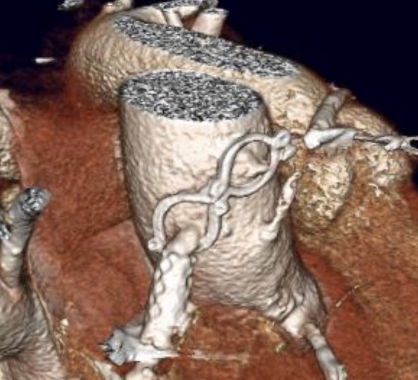 MAecocardio's tweet photo. Os animamos  a participar en nuestro III concurso #LaImagenMasBella de @imagencardiaca en  #33SEIC... premios  ;uno de nuestros Master.  Caso de Pablo Robles  de edicion Previa 2013 :AORTA MIOPE
» Paciente sometido a cirugía de bypass dispositivo con dispositivo U-clip https://t.co/qoOiVsrM1V