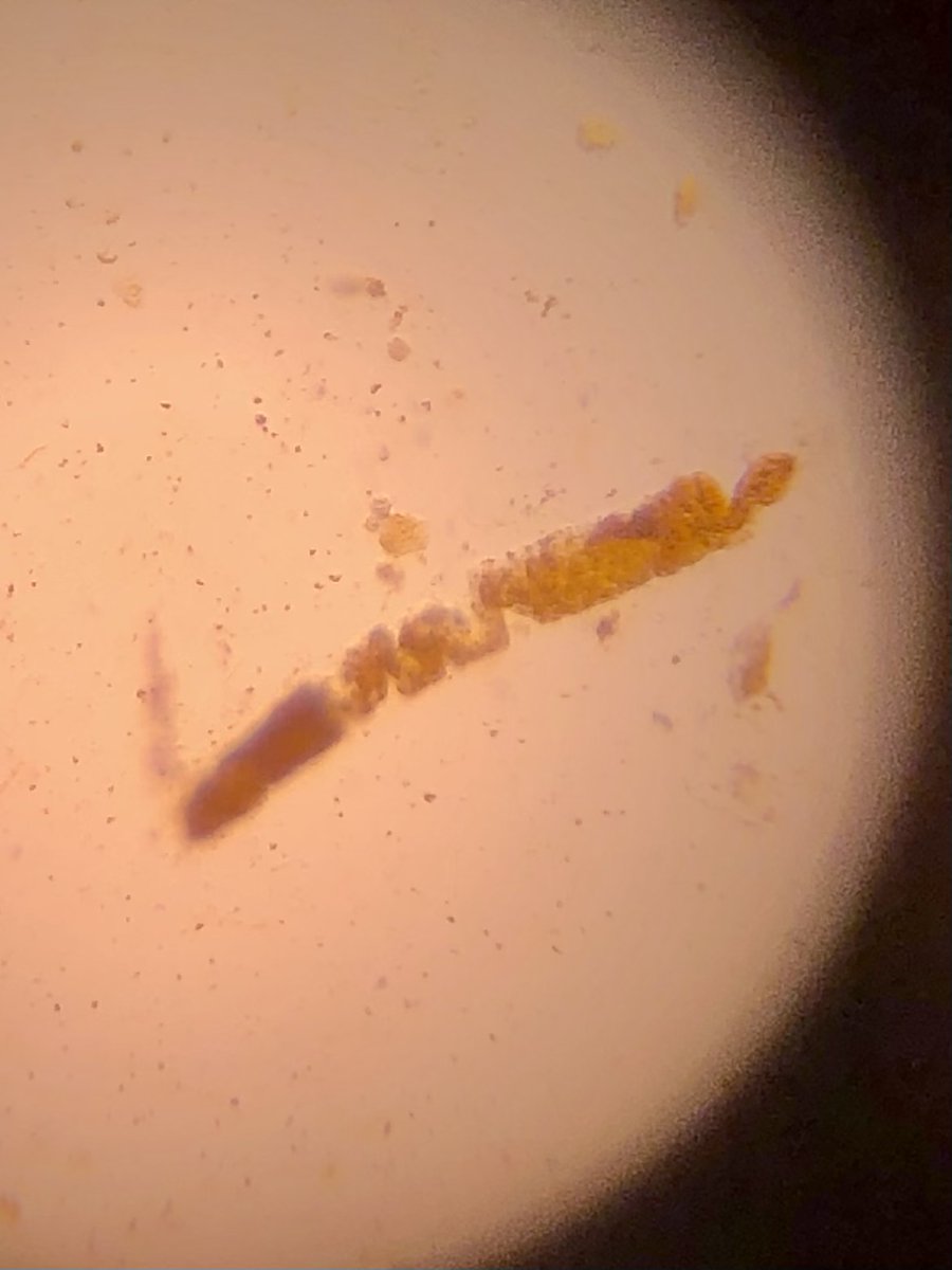 OnTheMEdWards's tweet photo. Check out this bile cast I stumbled upon in a case of obstructive jaundice and AKI. #LiquidBiopsy #NephMadness https://t.co/DisKvPlBvl