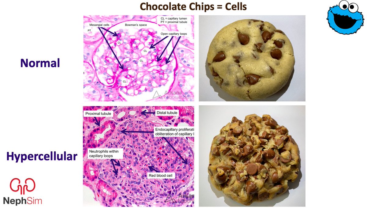More Chocolate Chips = Hypercellular Glomerulus

🍪🍪🍪

nephsim.com/pathology-appr…

#KidneyPath #FOAMed #MedEd <a href="/arkanalabs/">Arkana Laboratories</a> <a href="/Nephro_Sparks/">Matthew Sparks, MD</a>
