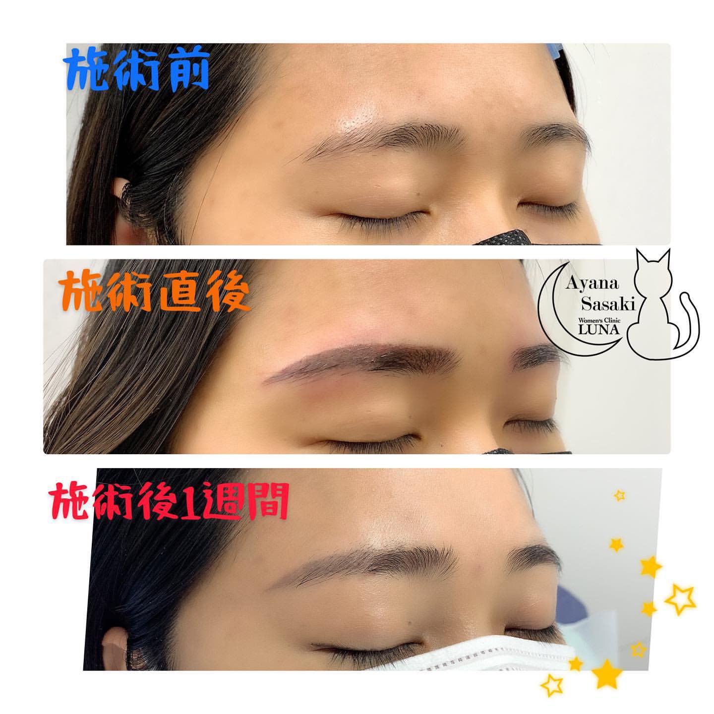 女性医療クリニックluna 公式 在 Twitter 上 グラデーション眉1回目の1週間後の経過です 直後は少し濃いめに入っていますが大体1週間で50 程に色味が落ち着きます T Co Xez2xfxrfc アートメイク アートメイク眉 美容 美容好きな人と繋がりたい Artmake