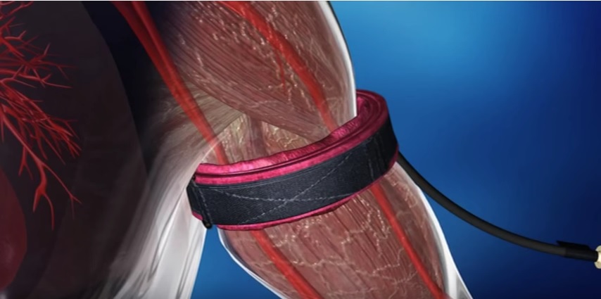 El entrenamiento de fuerza con baja carga con restricción de flujo sanguíneo conduce a cambios en la fuerza muscular, el volumen muscular y el dolor en la rehabilitación musculoesquelética comparables a los obtenidos con el entrenamiento convencional fisiologiaclinicadelejercicio.es/actualidad-fis…