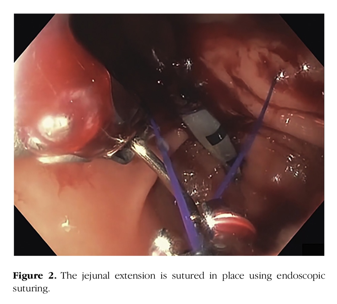 IBS_Maastricht's tweet photo. Endoscopic suturing - Could this finally be the solution to the misery of repetitiously dislocating J-extensions ❓🙏
#gastroparesis #PEGJ #endoscopy #feedingtube
https://t.co/GA82xfv9fV https://t.co/9pel0iHh8R