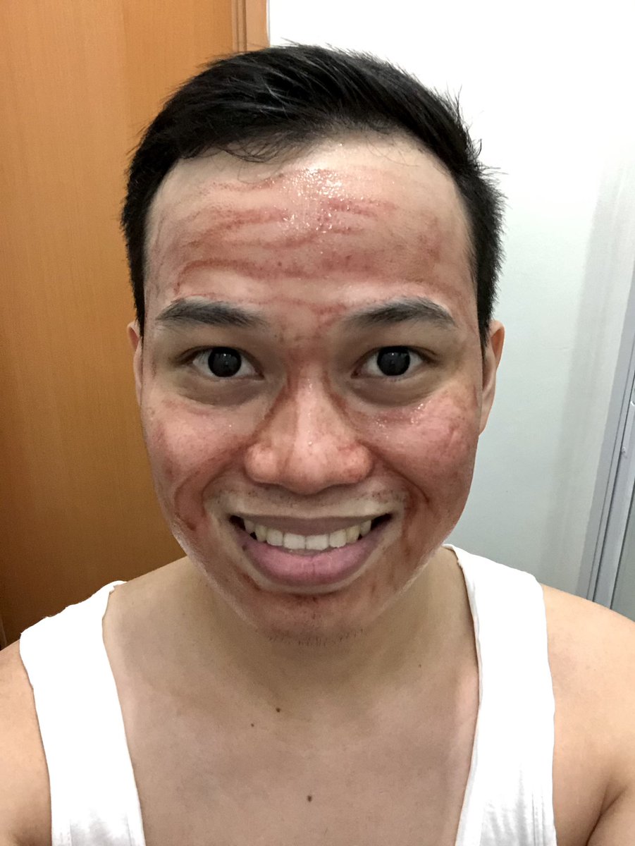 ianmlumbang's tweet photo. Much clearer skin in progress.... #peelday #theordinary #deciem #ahabha https://t.co/StaBybo3gh