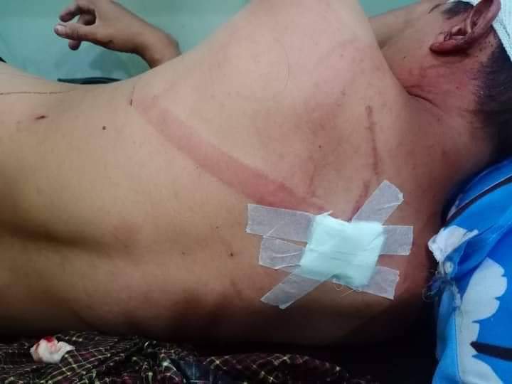 B851997's tweet photo. Tw // blood // graphic content⚠️
In Manawhari , MANDALAY, a man was chopped with knives by 4 military hired thugs around 8pm, last night. He got 3 cut wounds at his head &amp; back.

FREEDOM OF SPEECH 
#Mar21Coup
#WhatsHappeningInMyanmar https://t.co/ocskFKVdzg