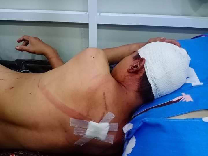B851997's tweet photo. Tw // blood // graphic content⚠️
In Manawhari , MANDALAY, a man was chopped with knives by 4 military hired thugs around 8pm, last night. He got 3 cut wounds at his head &amp; back.

FREEDOM OF SPEECH 
#Mar21Coup
#WhatsHappeningInMyanmar https://t.co/ocskFKVdzg