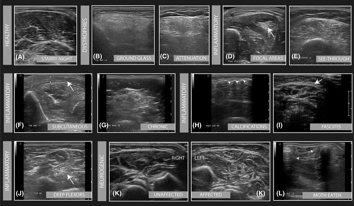 Do you use ultrasound to have a look at muscles/nerves?

Editorial <a href="/spiercentrum/">Spiercentrum Radboud</a> <a href="/MuscleAndNerve/">Muscle & Nerve</a> on ultrasound in routine clinical practice

onlinelibrary.wiley.com/doi/full/10.10…

#NeuroTwitter #MyoTwitter #Neurology #Physiatry #Rehabilitation #Pediatrics #NeuroRad #MSKRad #Neuromuscular #NMD