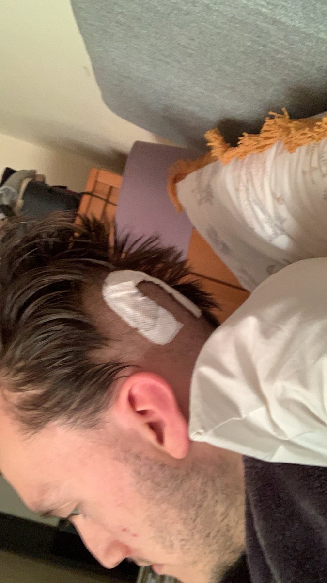 James_JosephTDL's tweet photo. *EXPLICIT SURGICAL CONTENT* 24th March 2020, I came round from surgery and here we are with the horseshoe scar as before, hair shaved yet again. the second surgery of 2020. To top it last week was #brainawarenessweek2020 and #NeurodiversityCelebrationWeek https://t.co/y7h5BXaU8j