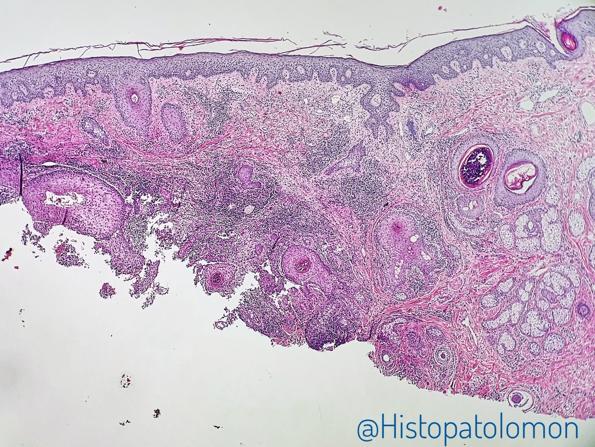 Histopatolomon's tweet photo. Perilolliculitis capitis abscedens et suffodiens, I love these descriptive terms. #dermpath #pathology #Hoffmandisease #Perilolliculitiscapitisabscedensetsuffodiens #dissectingcellulitis dissecting cellulitis of the scalp https://t.co/5b1J60PUPk