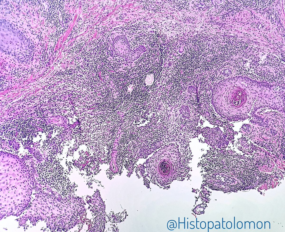 Histopatolomon's tweet photo. Perilolliculitis capitis abscedens et suffodiens, I love these descriptive terms. #dermpath #pathology #Hoffmandisease #Perilolliculitiscapitisabscedensetsuffodiens #dissectingcellulitis dissecting cellulitis of the scalp https://t.co/5b1J60PUPk