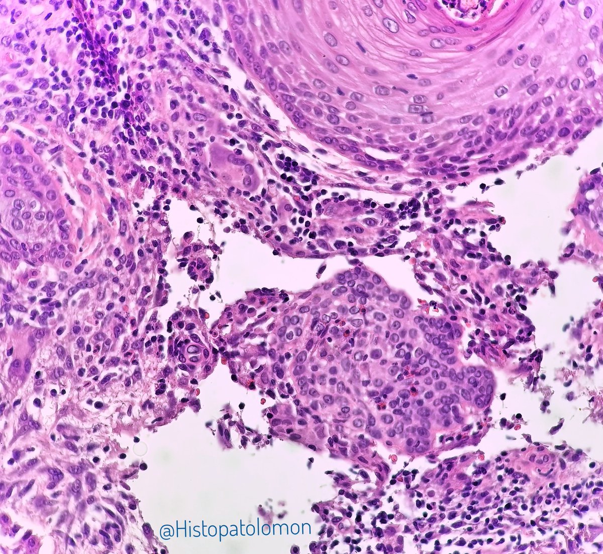 Histopatolomon's tweet photo. Perilolliculitis capitis abscedens et suffodiens, I love these descriptive terms. #dermpath #pathology #Hoffmandisease #Perilolliculitiscapitisabscedensetsuffodiens #dissectingcellulitis dissecting cellulitis of the scalp https://t.co/5b1J60PUPk