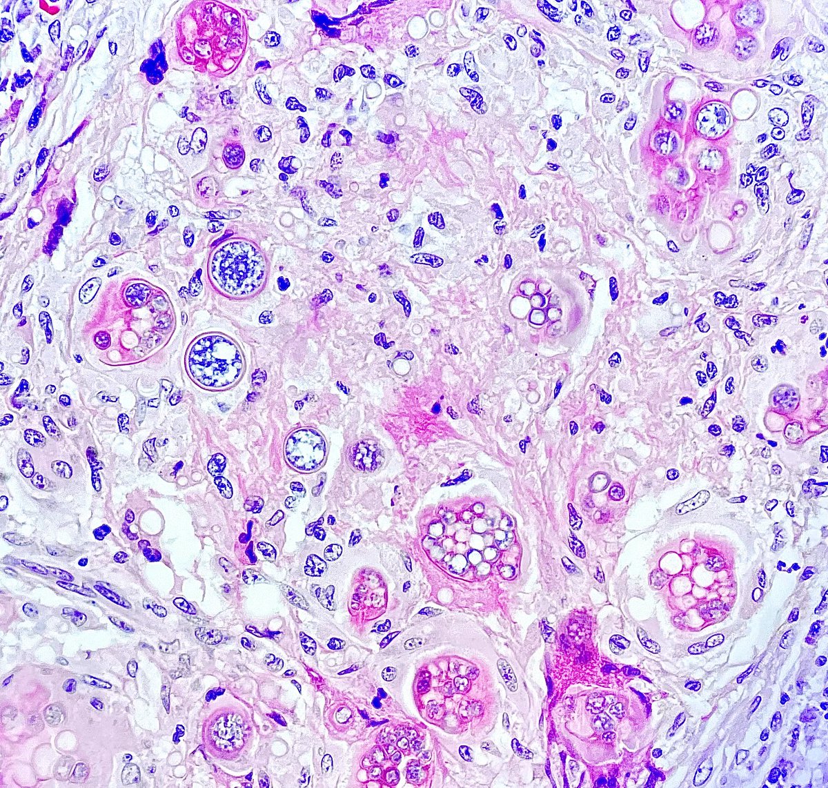 Have a nice sunday!!! Look at this beautiful coccidioidomycosis 🍄🔬#Pathology #PathTwitter #fungi #surgicalpath