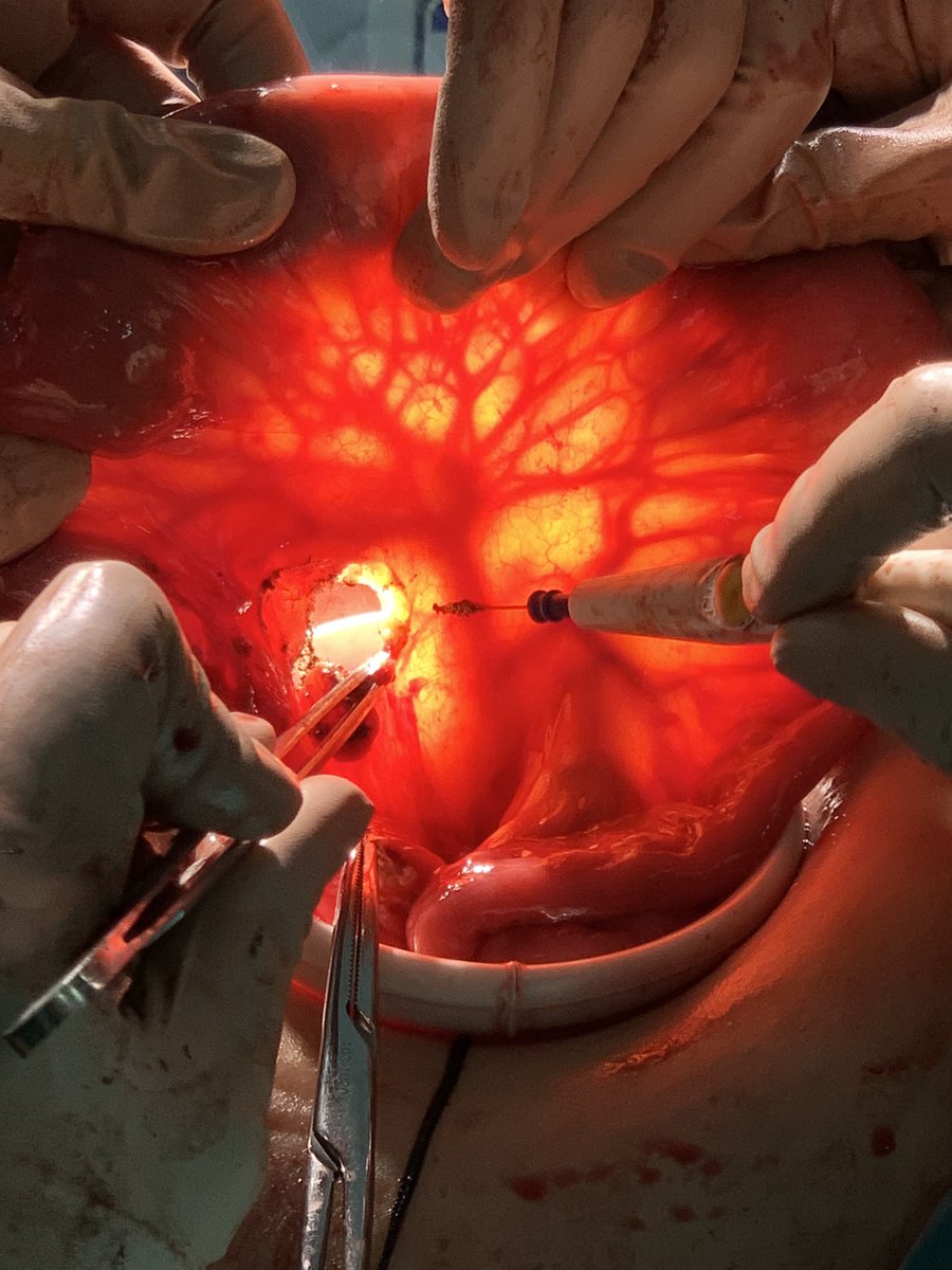 gianpag94's tweet photo. Almost two months passed since the beginning of my #generalsurgery residency. What I like the most about it?
Holding, all togheter, patients’ lives. @YouESCP @YouSICCR @CrohnsColitisFn @CrohnsColitisUK #IBD https://t.co/AztwEnZZaL