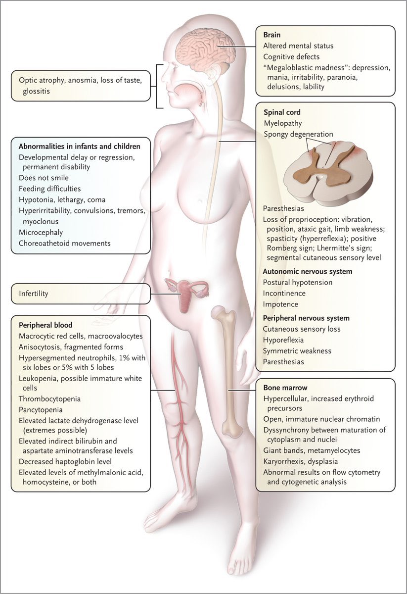 Complications of Vitamin B12 deficiency <a href="/NEJM/">NEJM</a> 

nejm.org/doi/full/10.10…