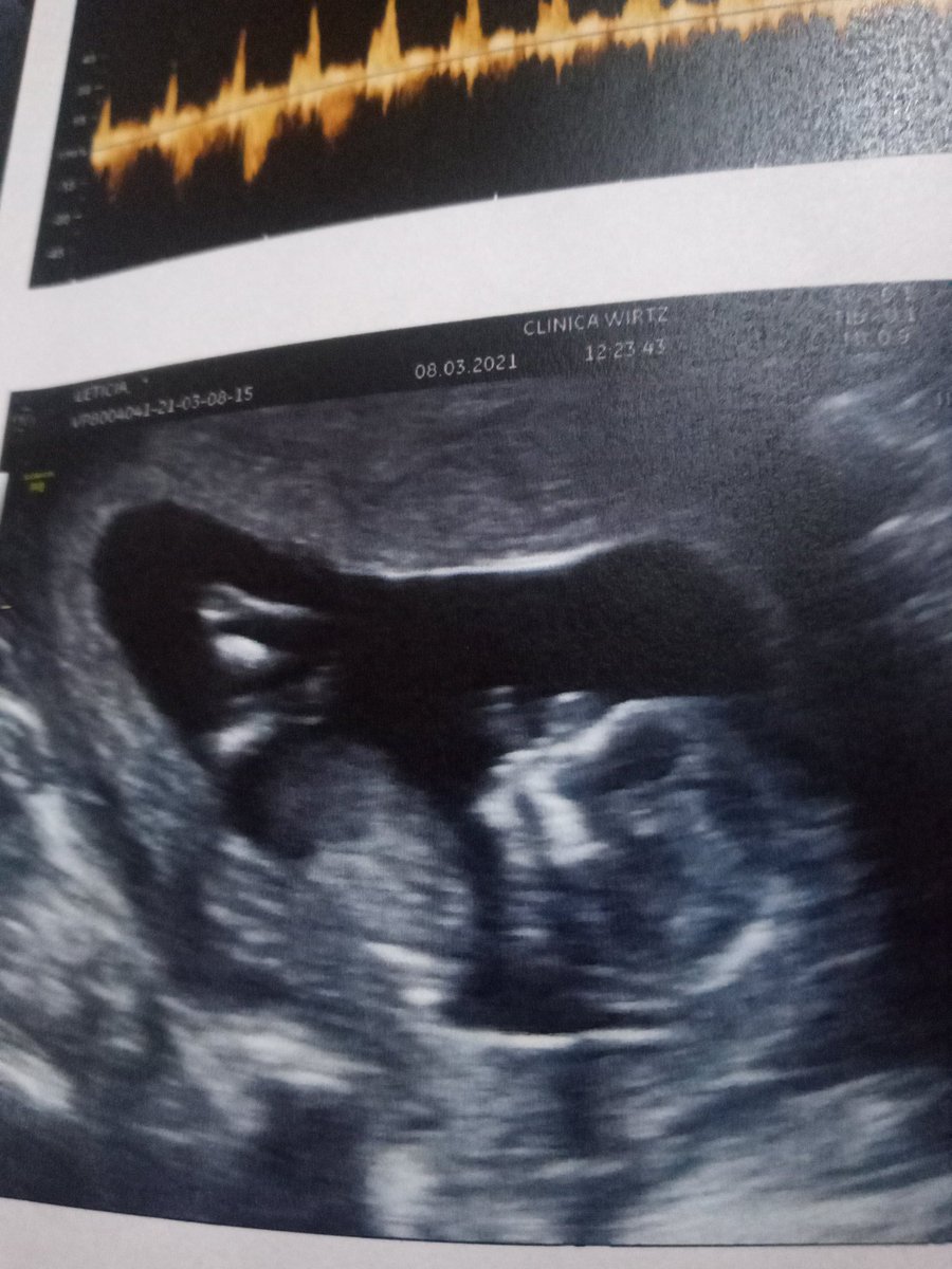 Leticia12876799's tweet photo. Minha injeção trimestral em dia, sem nenhum atraso com 4 meses, uma menina 😅  mamãe novamente rs https://t.co/XAj4UVTy0U