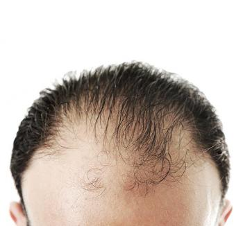 Причины выпадения волос у подростка. Выпадение волос у мужчин. Человек с лысиной на затылке.