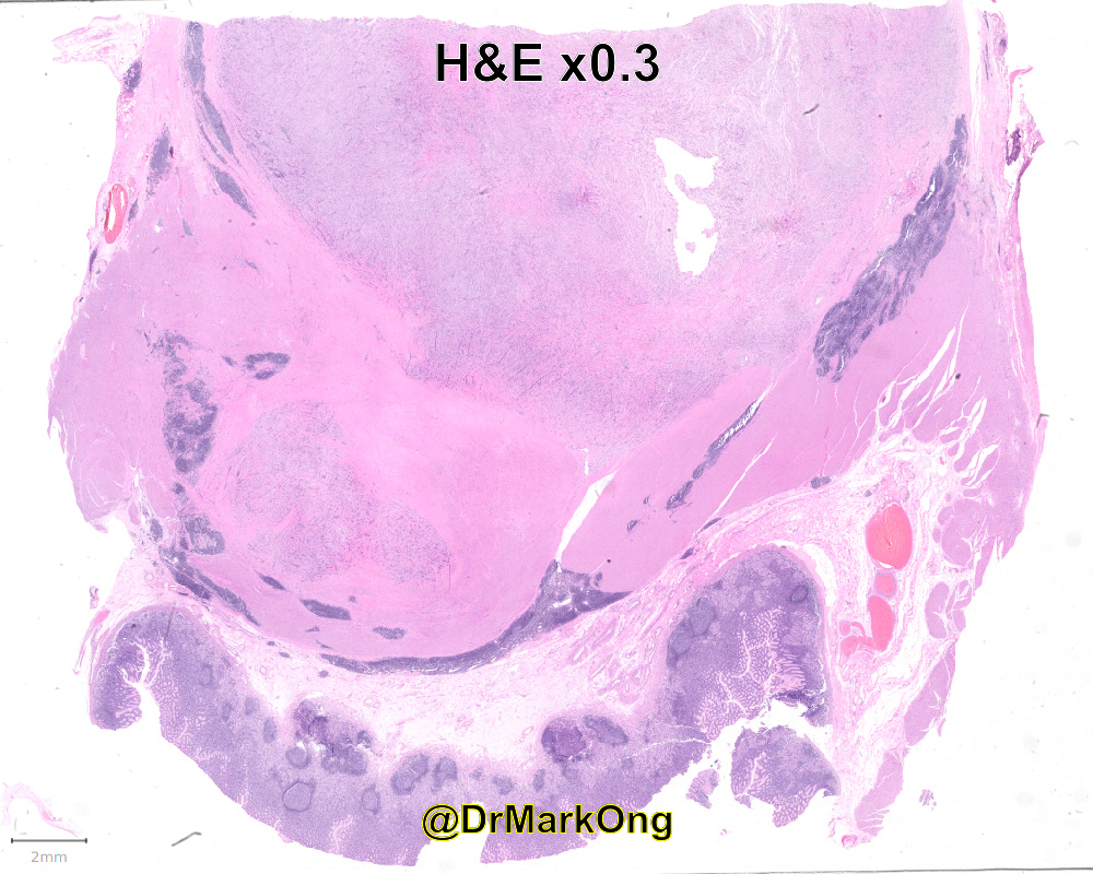 Resection of gastric mass in adult.

What's your low power diagnosis? Or for bonus points, diagnoses?

#LPpath #GIpath