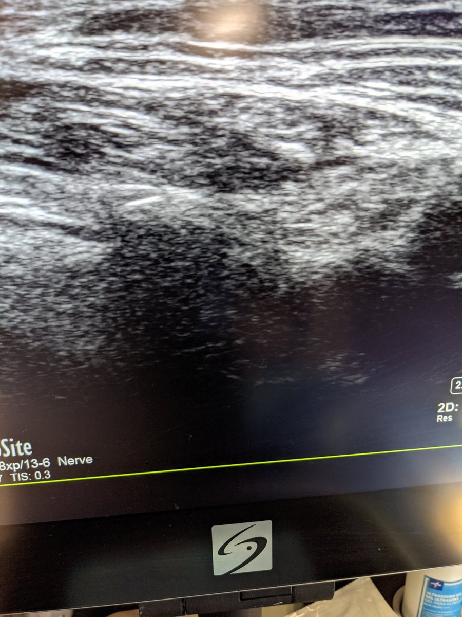 patel_hamil's tweet photo. Did my first Iliaca fascia block today and pleasently surprised at how easy and effective it is for hip and femur fractures. Certainly plan to continue in my practice @MegCrossEM @EinsteinEMed https://t.co/WD3IuOqCeH