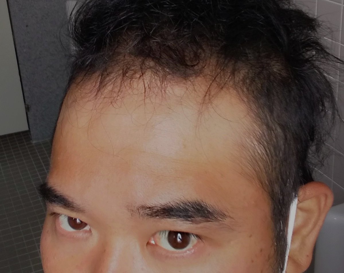 まっかちゅ お疲れ様です ハゲて広がったおでこ なんとなく帽子とデコとの間で色の変わりが分かる 笑 清掃会社なのに草刈りばかりしてるとこんな焼け方をするとは さすが沖縄 まっかちゅ お疲れ様です ハゲて広がったおでこ なんとなく帽子とデコとの間で色の変わりが分かる 笑 清掃会社なのに草刈りばかりしてるとこんな焼け方をするとは さすが沖縄