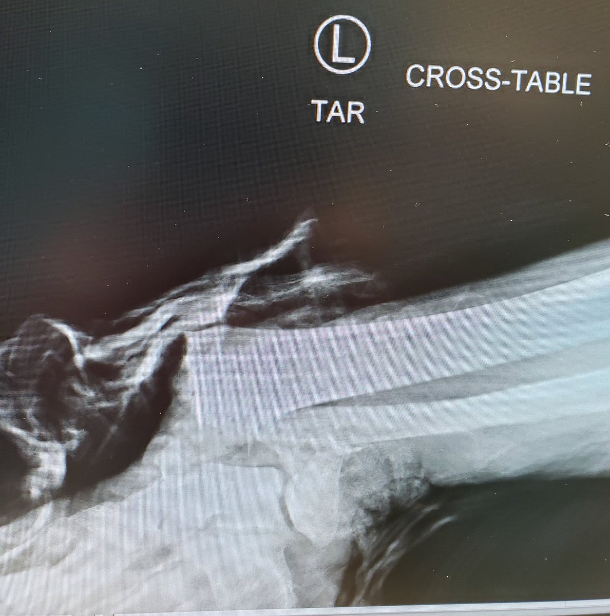 Not every ankle fx needs a gravity stress view...but thank you.