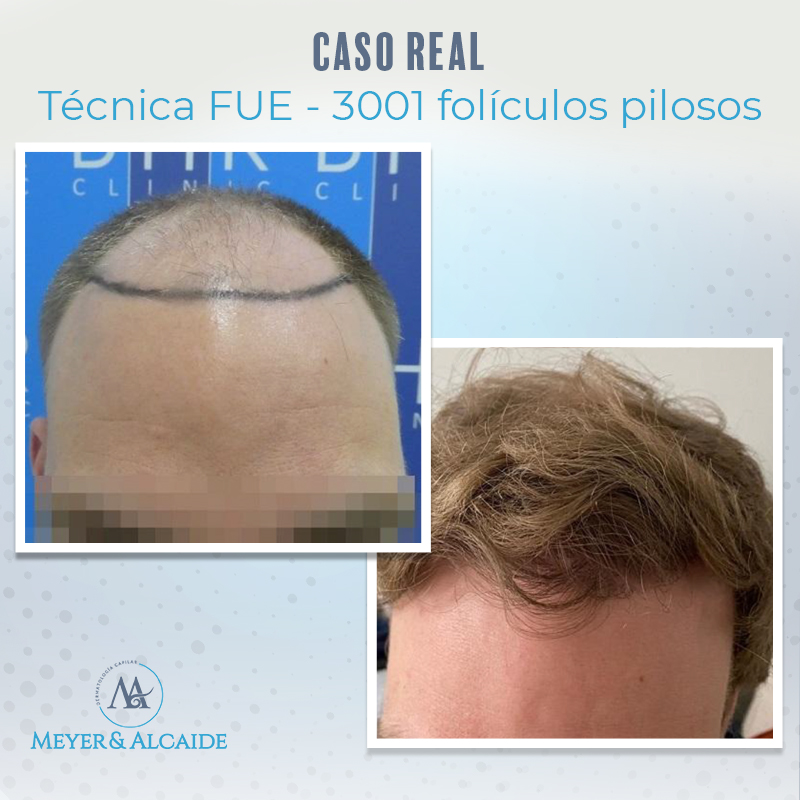 MeyeryAlcaide's tweet photo. #InsjertoCapilar con la #TécnicaFUE. Un total de 3.001 #folículos pilosos fueron extraídos del paciente e implantados, proporcionando así la imagen deseada por él.

Dile adiós a la alopecia con nosotros. ¡Llámanos al 626 29 09 33! ☎️

#MeyeryAlcaide #Málaga #DermatologíaCapilar https://t.co/0kpva6a5f7