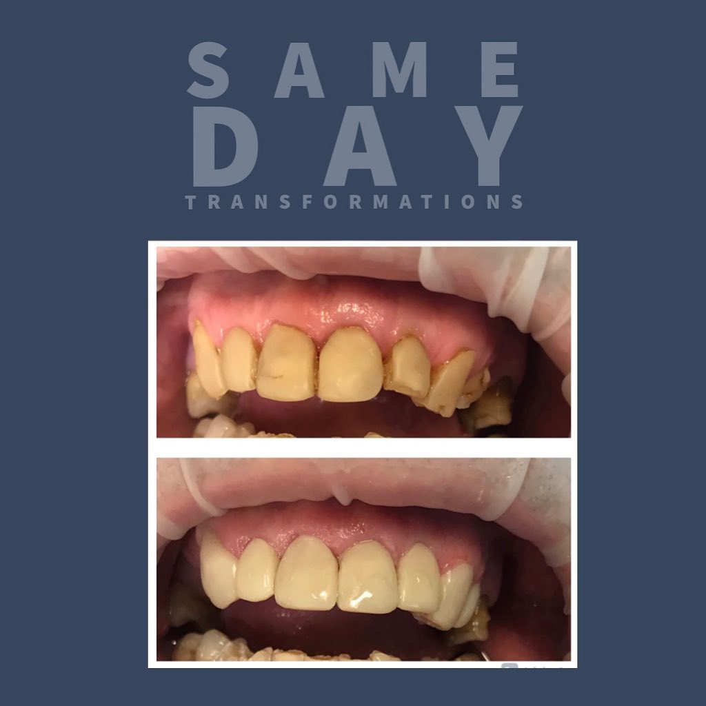 Just the smile on this patient once we had completed their composite bonding was enough to make our Friday complete! 😁

Composite bonding is a regular treatment provided in practice; &amp; we can offer a variety of techniques (free hand &amp; injection moulding).