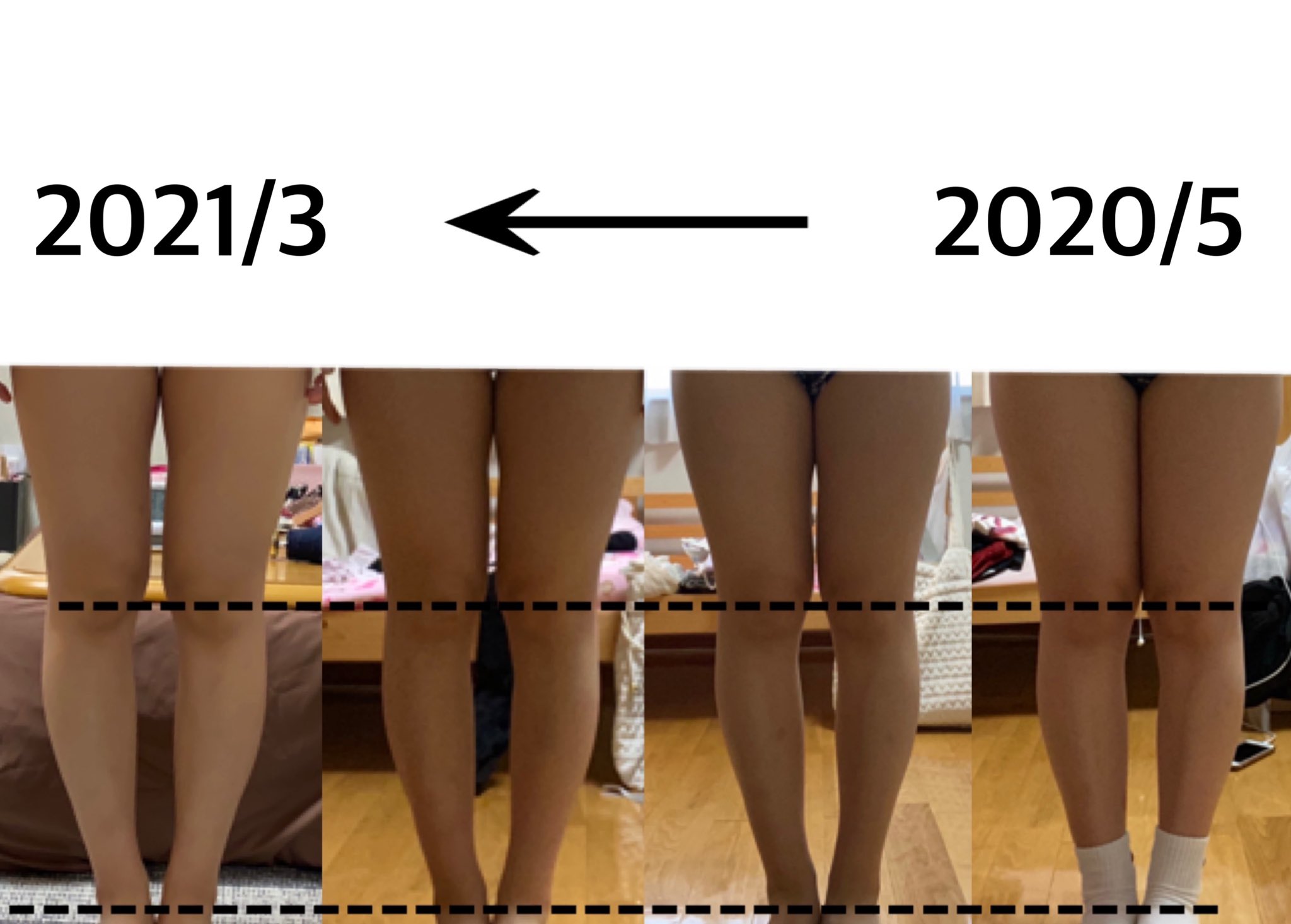 ぷ 比較してみたら 自分で感動しちゃった 昔から足が太いのがコンプレックスで自分の足は細くならない んだって思い込んでたけど頑張ってよかった 久しぶりにショーパン買ったから春夏これを堂々と着れるようにもっと脚痩せ頑張る ダイエットビフォー