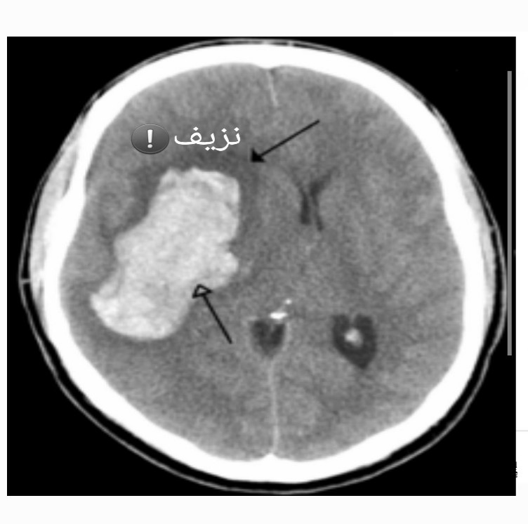drfaisalalmalki's tweet image. اهمال ارتفاع ضغط الدم ..
(صورة للدماغ بواسطة الأشعة المقطعية)