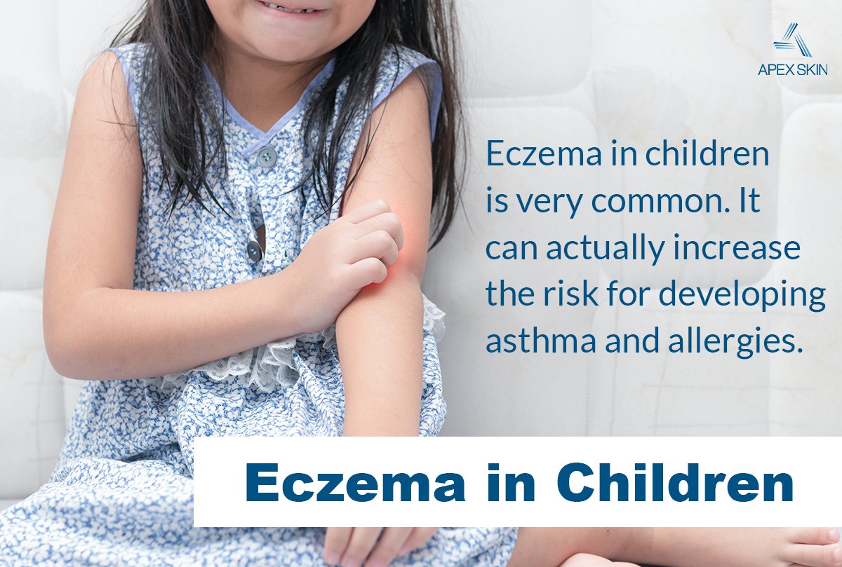 Eczema is a common skin condition in children. Our dermatology providers are the experts and help kids and their parents to keep it under control!

Read more at apexskin.com/blog or schedule to see us at on of our 10 locations!

#eczema #dermatitis #dryskin #dermatology