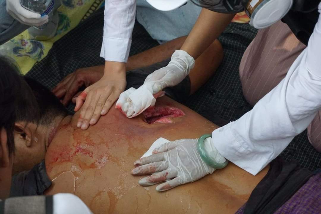 The last Martyr fell today in Mandalay. Some people said that it is 'NATO bullet'.
As for me, I have never seen this kind of bullet in my lifetime. How can they use such kind of weapon to unarmed citizen?
#AgainstMyanmarMilitaryCoup 
#DrSasa 
#22/3/2021