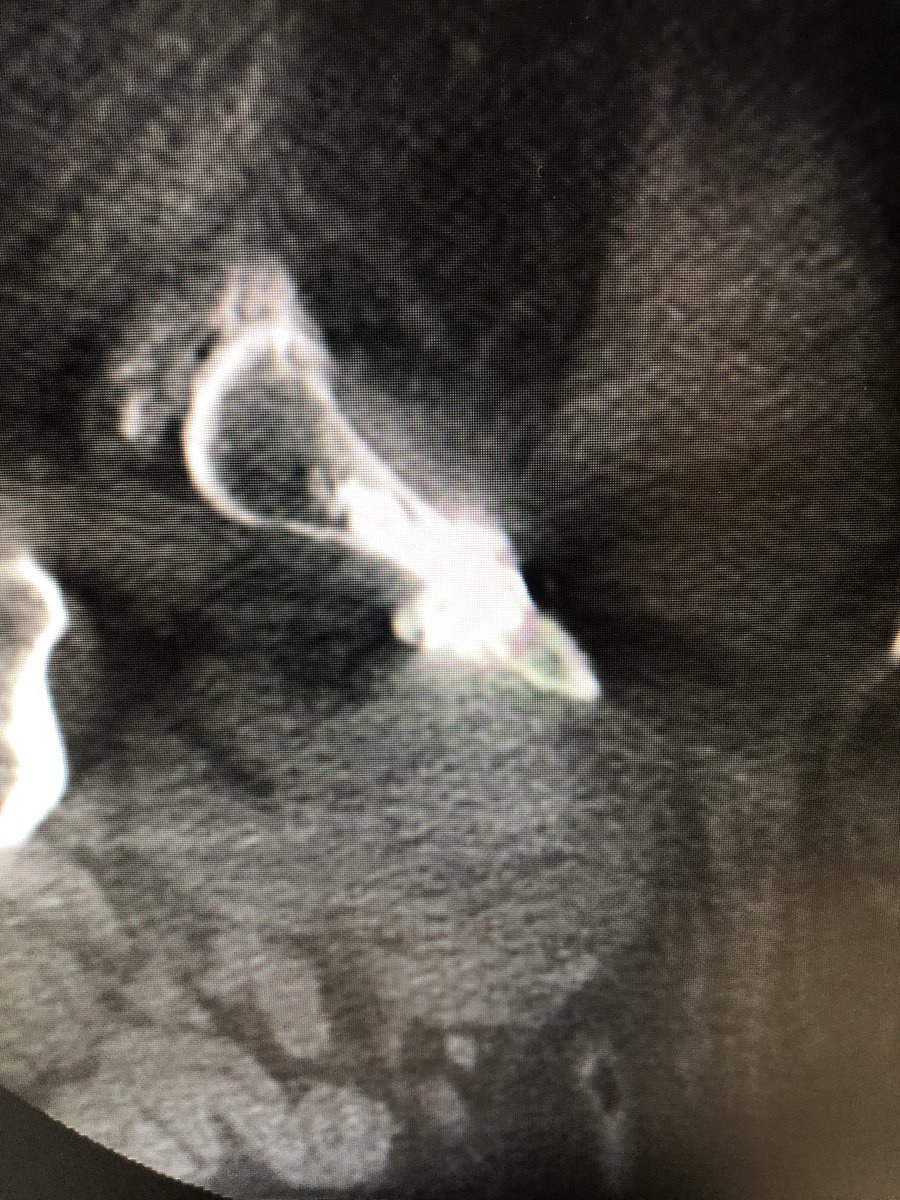 Pathologic inf. pubic ramus fracture w/ nonunion on high dose #opioids. <a href="/BostonPIMedEd/">Boston Scientific PI MedEd</a> Cryoablation, Reduction Osteoplasty, and “Rebar/Scaffold” Stent-Assisted Nonunion Cementoplasty w/<a href="/Medtronic_Spine/">Medtronic Spine</a>’s PMMA ➡️ immediate post-op pain relief. #twitIR #orthotwitter <a href="/SIRspecialists/">Society of Interventional Radiology</a>