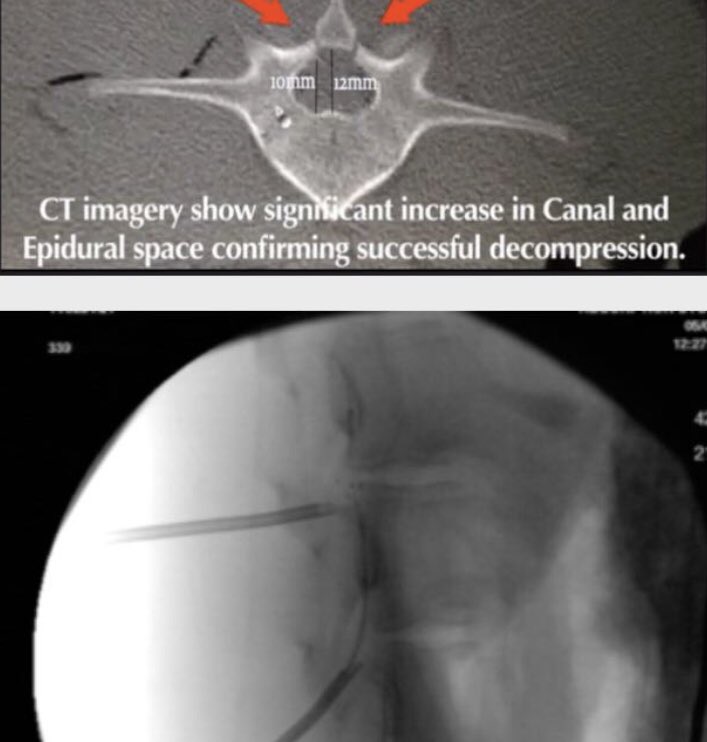 tariqtramboo's tweet photo. Lab in Sandiego USA, where me and my team have worked continuously without rest - We finally achieved the breakthrough in discovering the technique for non surgical spinal decompression #Spineloop. https://t.co/MjZ8aobOG9