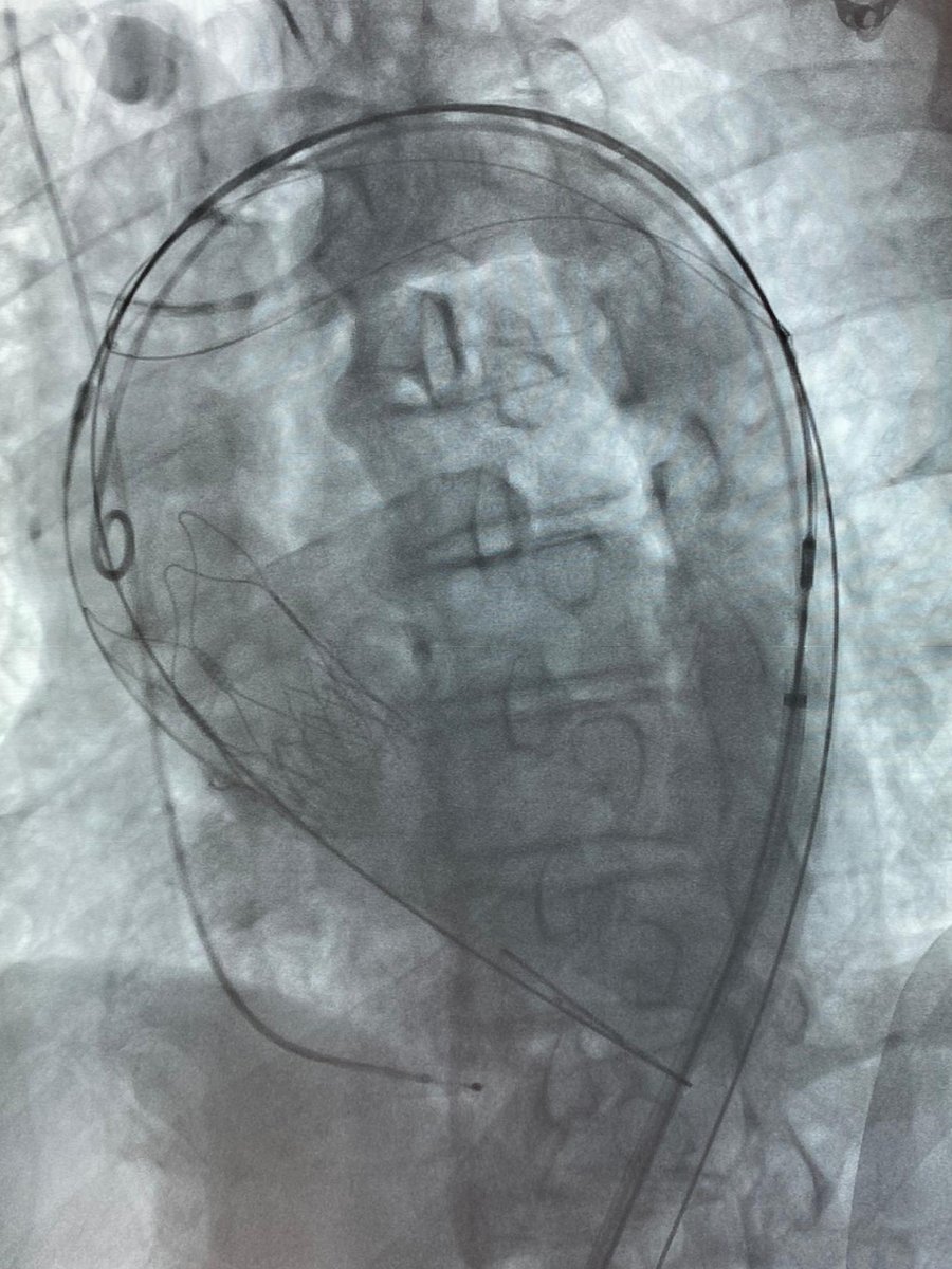 CARDIVAGROUP's tweet photo. #HeartTeam El equipo de hemodinámica del Hospital Cruz Vermelha de Lisboa consigue realizar con éxito el primer caso en Portugal con el dispositivo de protección embólica cerebral de @Keystone_Heart https://t.co/5wKjbDm3Y6
