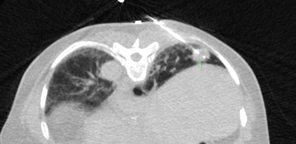 bhavinj's tweet photo. UIP IPF with lung nodule for biopsy
https://t.co/IVAKUVF7Lu
#ctbiopsy #lungnodulebiopsy #lungbiopsy #squamousca https://t.co/UzwSTfeAdg