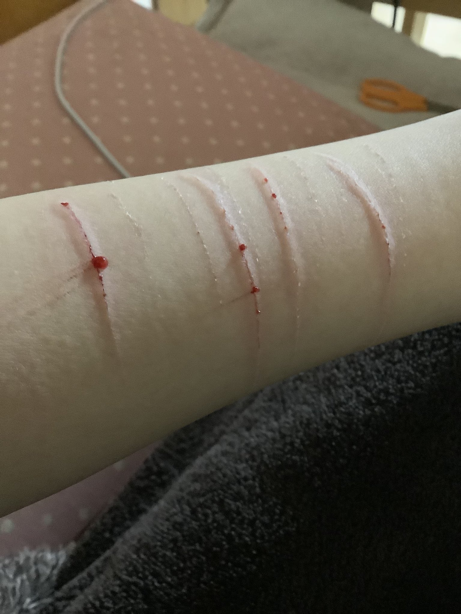 もっちゃん ʚ ɞ 今日は我慢してハサミで なんか血が玉みたいになってて草 リストカット リスカ リスカ画像 アムカ リスカ跡 アムカ跡 T Co Nstyfoafx2 Twitter