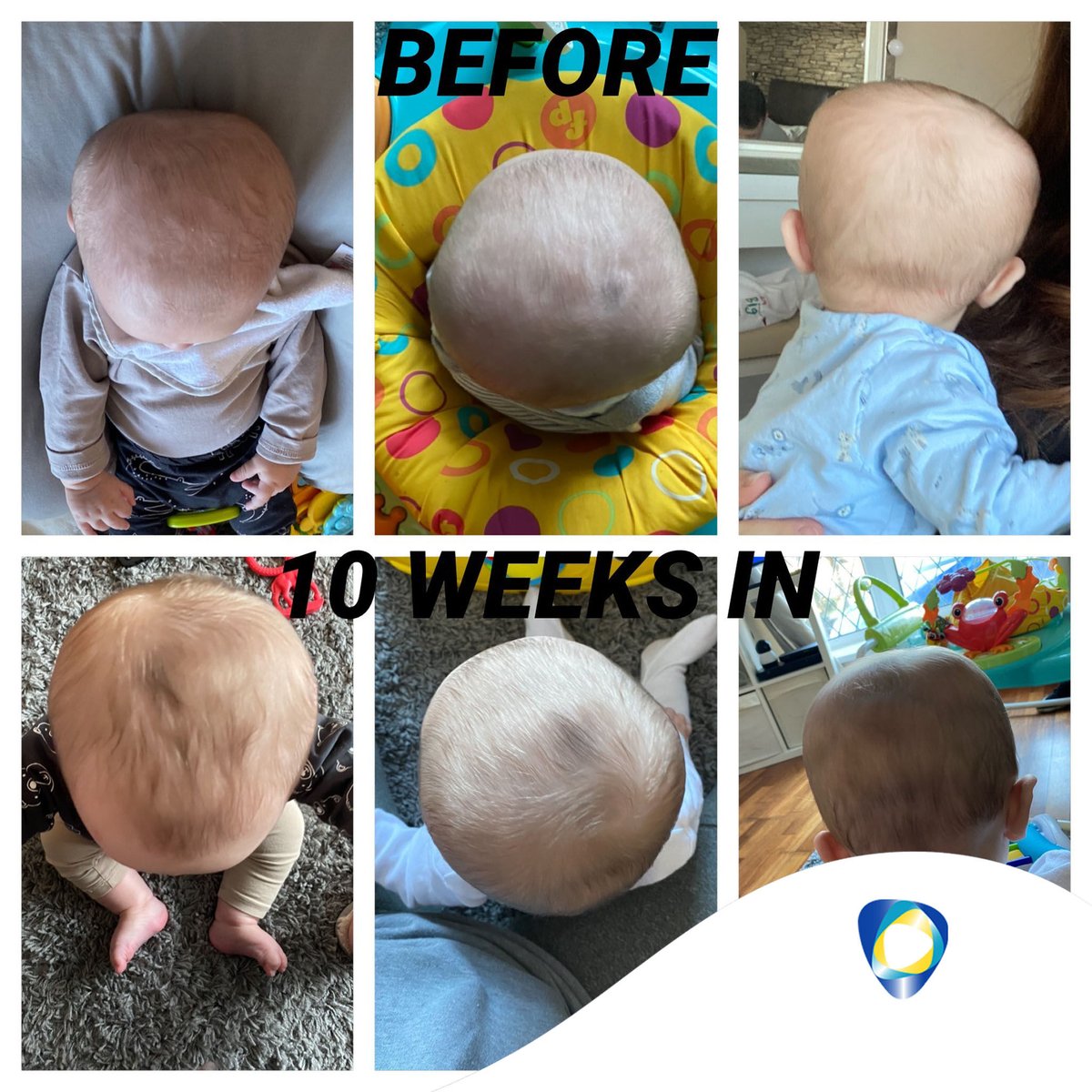 technoinmotion's tweet photo. Meet Jesse, who started his TiMband Air journey some time ago and has completed his treatment.

Georgia gave us her full story which you can read with the link below:

https://t.co/PLl2aqFIkJ

#technologyinmotion #timbandair #flatheadsyndrome https://t.co/akr2oqB3tZ